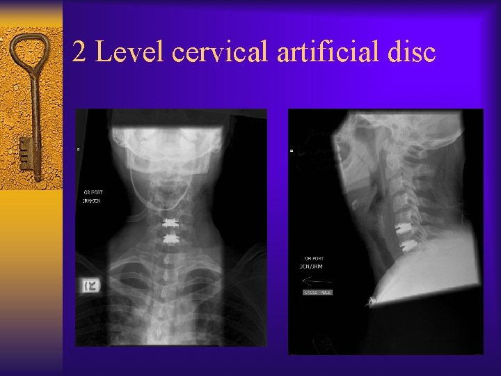 2 Level cervical artificial disc 