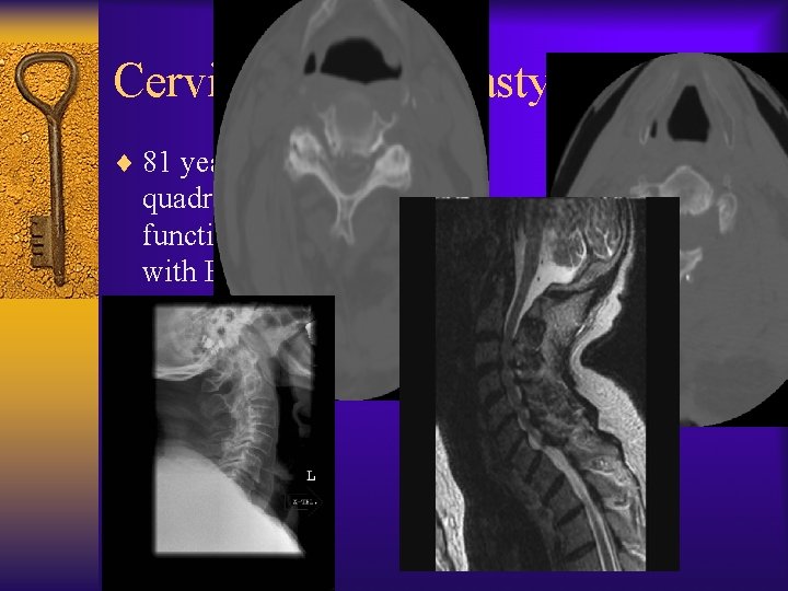 Cervical Laminoplasty ¨ 81 year old with quadriparesis, loss of function of all 4,