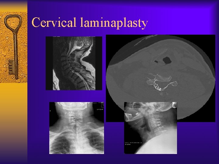 Cervical laminaplasty 