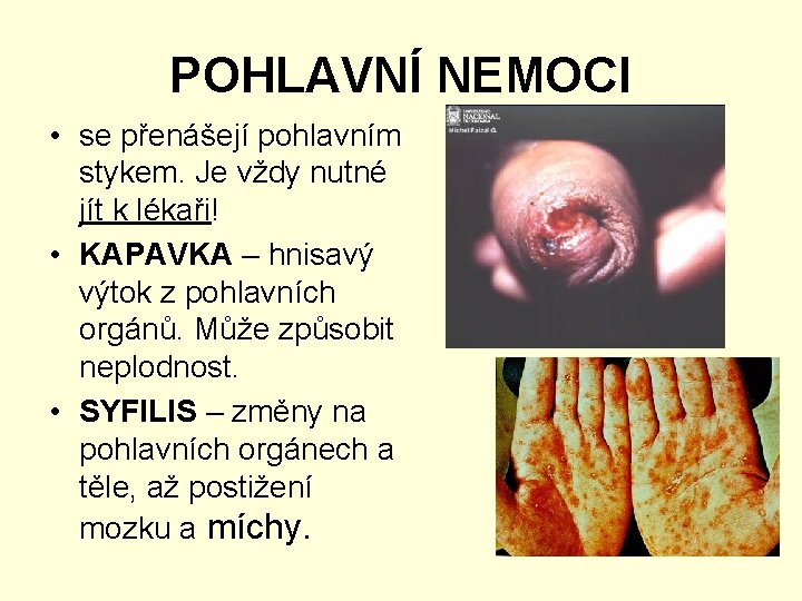 POHLAVNÍ NEMOCI • se přenášejí pohlavním stykem. Je vždy nutné jít k lékaři! •