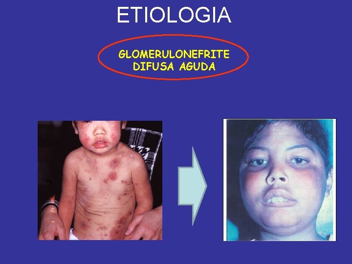 ETIOLOGIA GLOMERULONEFRITE DIFUSA AGUDA 