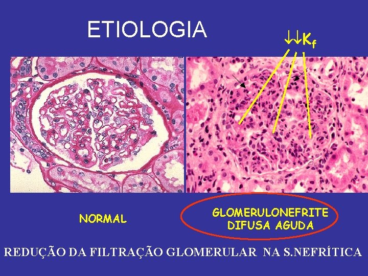 ETIOLOGIA NORMAL Kf GLOMERULONEFRITE DIFUSA AGUDA REDUÇÃO DA FILTRAÇÃO GLOMERULAR NA S. NEFRÍTICA 