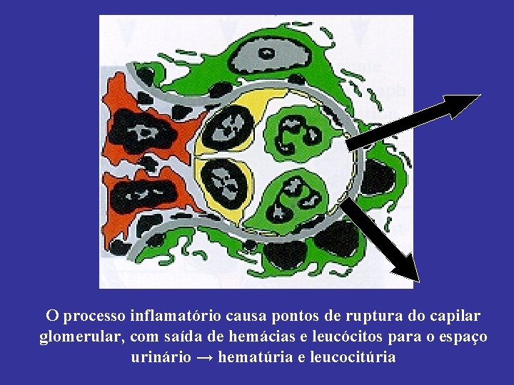 O processo inflamatório causa pontos de ruptura do capilar glomerular, com saída de hemácias