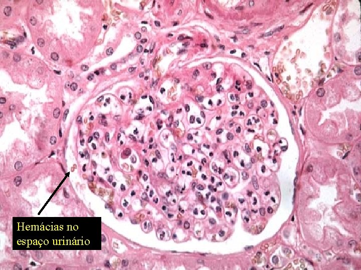 Hemácias no espaço urinário 