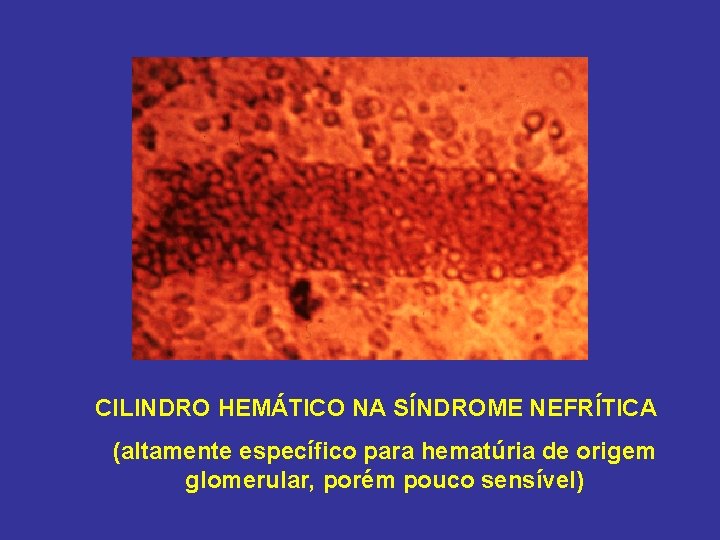 CILINDRO HEMÁTICO NA SÍNDROME NEFRÍTICA (altamente específico para hematúria de origem glomerular, porém pouco