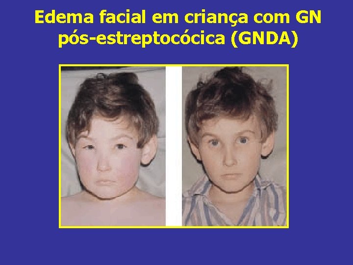 Edema facial em criança com GN pós-estreptocócica (GNDA) 