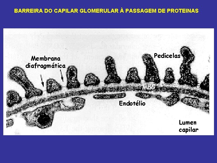 BARREIRA DO CAPILAR GLOMERULAR À PASSAGEM DE PROTEINAS Pedicelas Membrana diafragmática MBG Endotélio Lumen