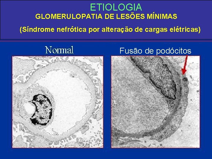 ETIOLOGIA GLOMERULOPATIA DE LESÕES MÍNIMAS (Síndrome nefrótica por alteração de cargas elétricas) Fusão de