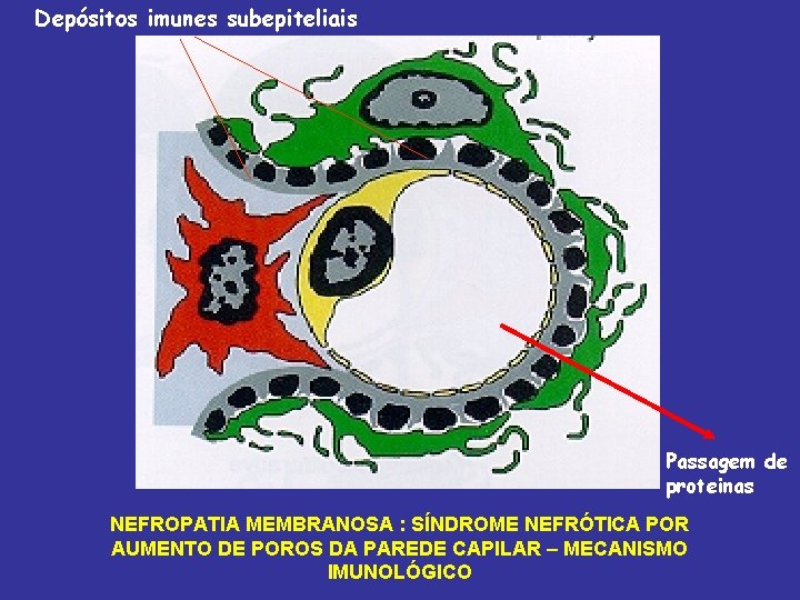 Depósitos imunes subepiteliais Passagem de proteinas NEFROPATIA MEMBRANOSA : SÍNDROME NEFRÓTICA POR AUMENTO DE