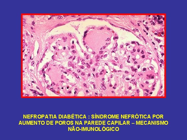 NEFROPATIA DIABÉTICA : SÍNDROME NEFRÓTICA POR AUMENTO DE POROS NA PAREDE CAPILAR – MECANISMO