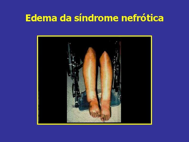 Edema da síndrome nefrótica 