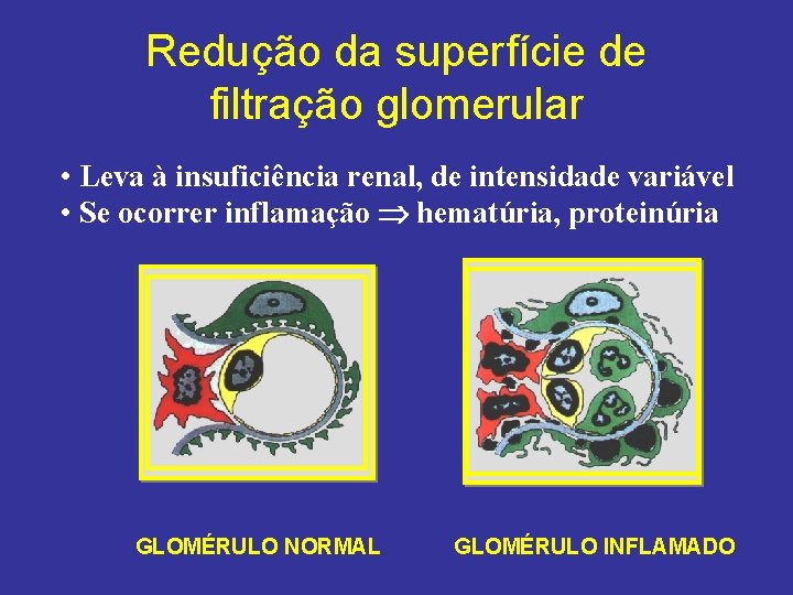 Redução da superfície de filtração glomerular • Leva à insuficiência renal, de intensidade variável