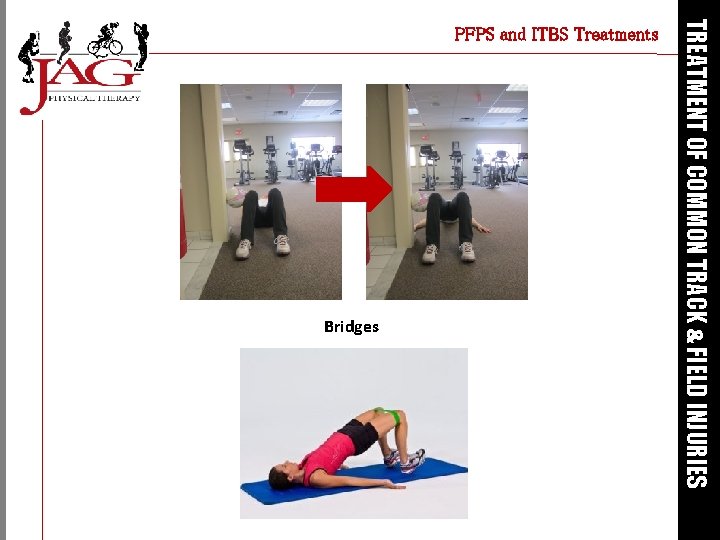 Bridges TREATMENT OF COMMON TRACK & FIELD INJURIES PFPS and ITBS Treatments 