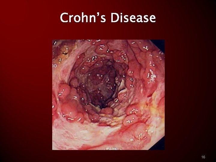 Crohn’s Disease 16 