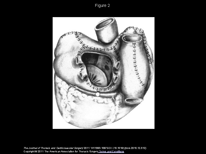 Figure 2 The Journal of Thoracic and Cardiovascular Surgery 2011 1411093 -1097 DOI: (10.