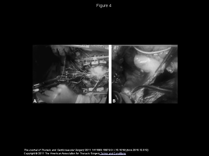 Figure 4 The Journal of Thoracic and Cardiovascular Surgery 2011 1411093 -1097 DOI: (10.
