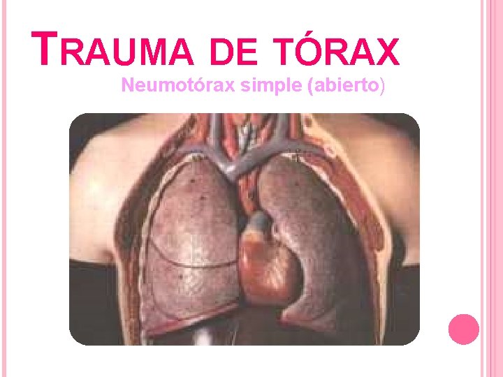 TRAUMA DE TÓRAX Neumotórax simple (abierto) 