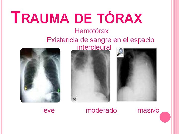 TRAUMA DE TÓRAX Hemotórax Existencia de sangre en el espacio interpleural leve moderado masivo