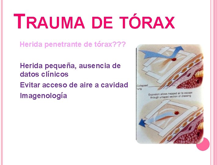 TRAUMA DE TÓRAX Herida penetrante de tórax? ? ? Herida pequeña, ausencia de datos
