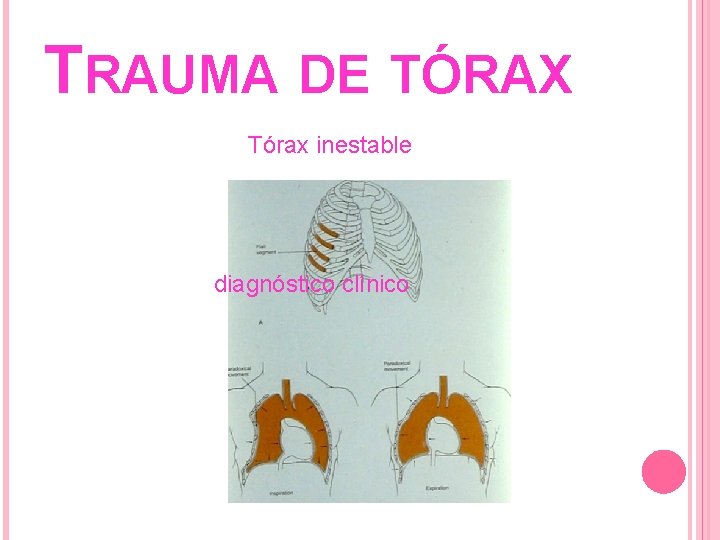 TRAUMA DE TÓRAX Tórax inestable diagnóstico clínico 