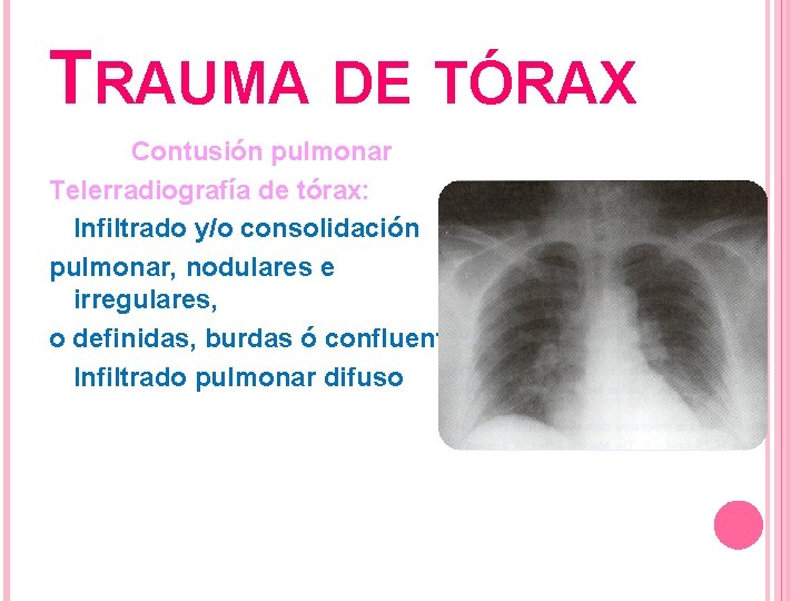 TRAUMA DE TÓRAX Contusión pulmonar Telerradiografía de tórax: Infiltrado y/o consolidación pulmonar, nodulares e