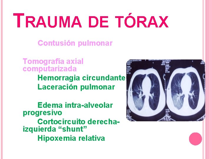 TRAUMA DE TÓRAX Contusión pulmonar Tomografía axial computarizada Hemorragia circundante Laceración pulmonar Edema intra-alveolar
