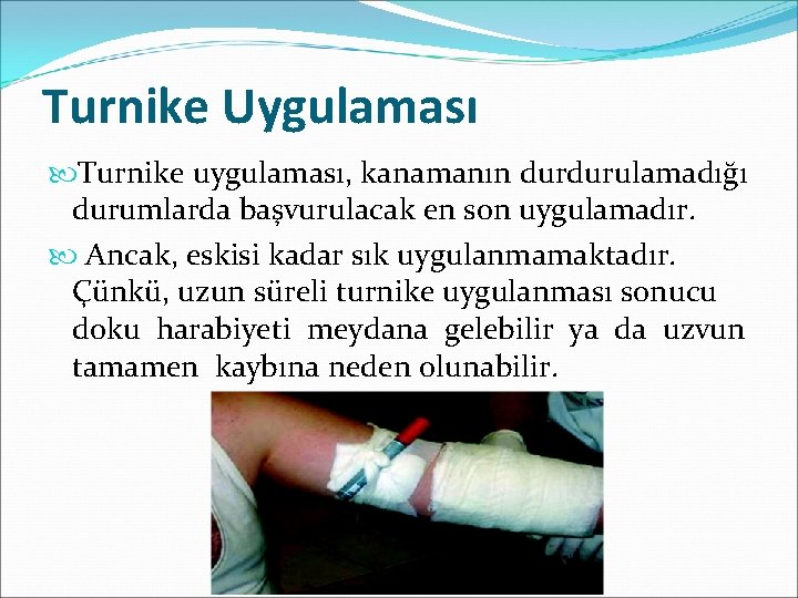 Turnike Uygulaması Turnike uygulaması, kanamanın durdurulamadığı durumlarda başvurulacak en son uygulamadır. Ancak, eskisi kadar