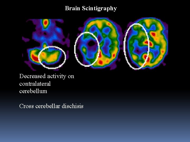 Brain Scintigraphy Decreased activity on contralateral cerebellum Cross cerebellar dischisis 