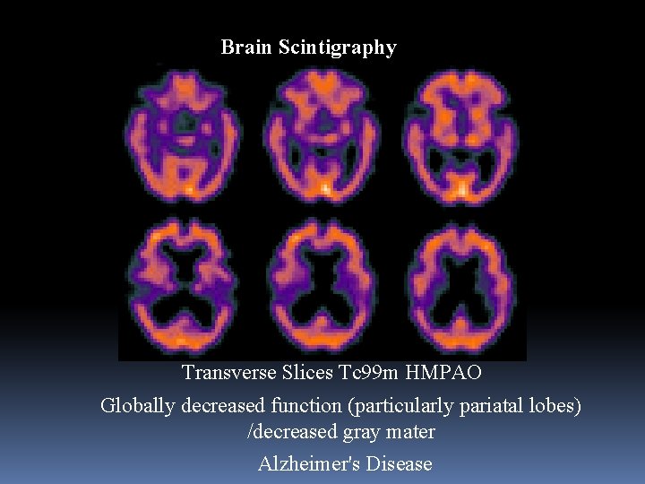 Brain Scintigraphy Transverse Slices Tc 99 m HMPAO Globally decreased function (particularly pariatal lobes)