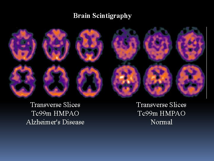 Brain Scintigraphy Transverse Slices Tc 99 m HMPAO Alzheimer's Disease Transverse Slices Tc 99