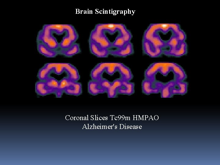 Brain Scintigraphy Coronal Slices Tc 99 m HMPAO Alzheimer's Disease 