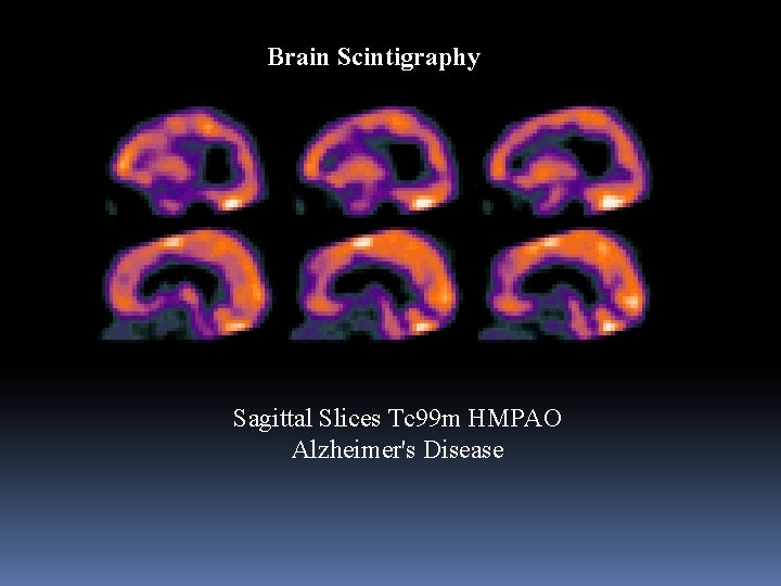 Brain Scintigraphy Sagittal Slices Tc 99 m HMPAO Alzheimer's Disease 