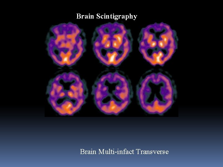 Brain Scintigraphy Brain Multi-infact Transverse 