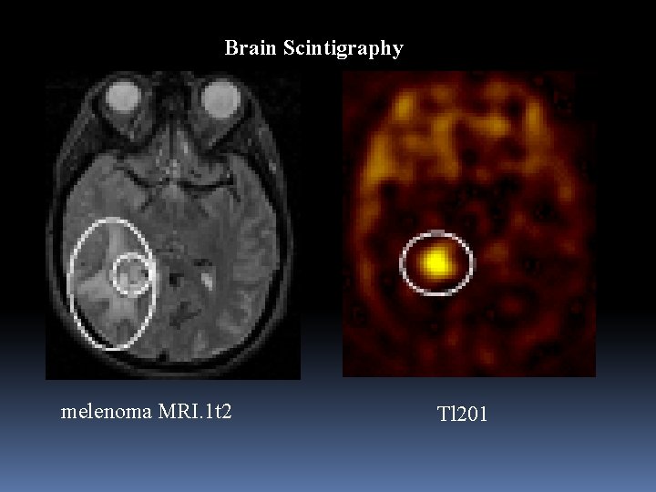 Brain Scintigraphy melenoma MRI. 1 t 2 Tl 201 
