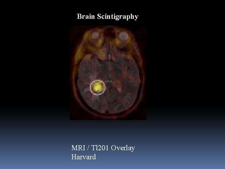 Brain Scintigraphy MRI / Tl 201 Overlay Harvard 