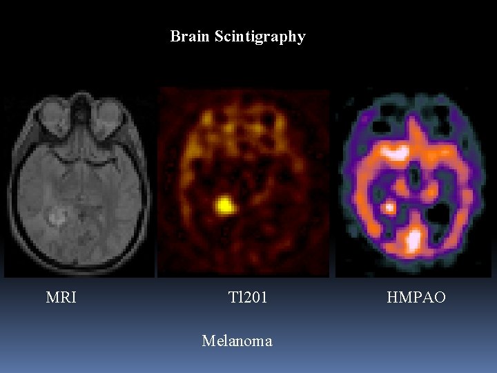 Brain Scintigraphy MRI Tl 201 Melanoma HMPAO 