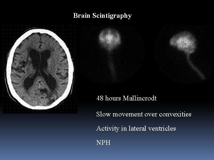 Brain Scintigraphy 48 hours Mallincrodt Slow movement over convexities Activity in lateral ventricles NPH