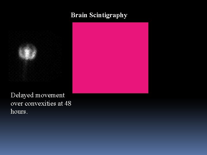 Brain Scintigraphy Delayed movement over convexities at 48 hours. 