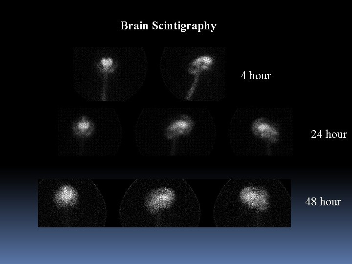Brain Scintigraphy 4 hour 24 hour 48 hour 