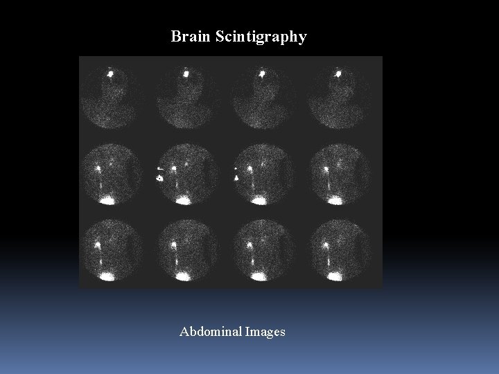 Brain Scintigraphy Abdominal Images 
