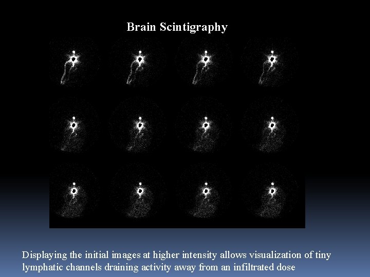 Brain Scintigraphy Displaying the initial images at higher intensity allows visualization of tiny lymphatic