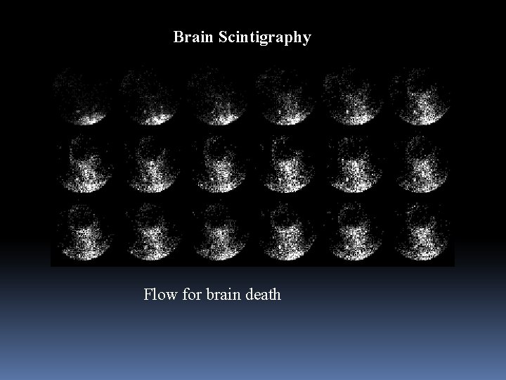 Brain Scintigraphy Flow for brain death 