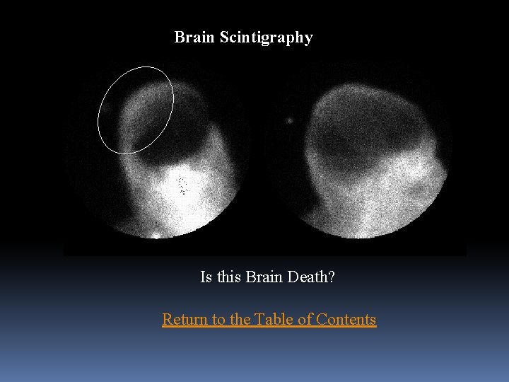 Brain Scintigraphy Is this Brain Death? Return to the Table of Contents 