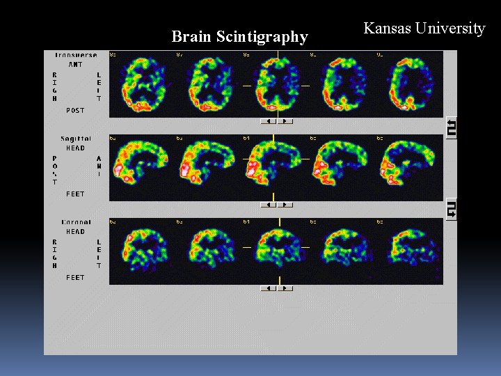 Brain Scintigraphy Kansas University 