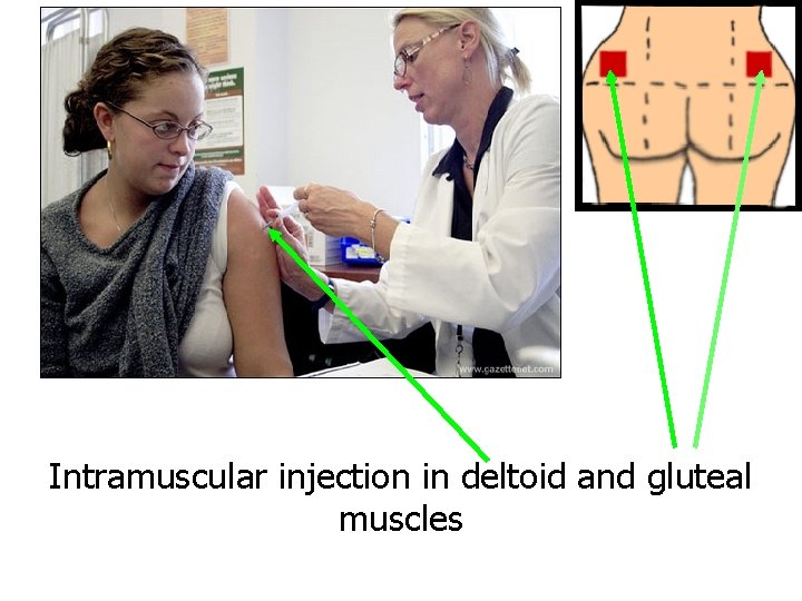 Intramuscular injection in deltoid and gluteal muscles 