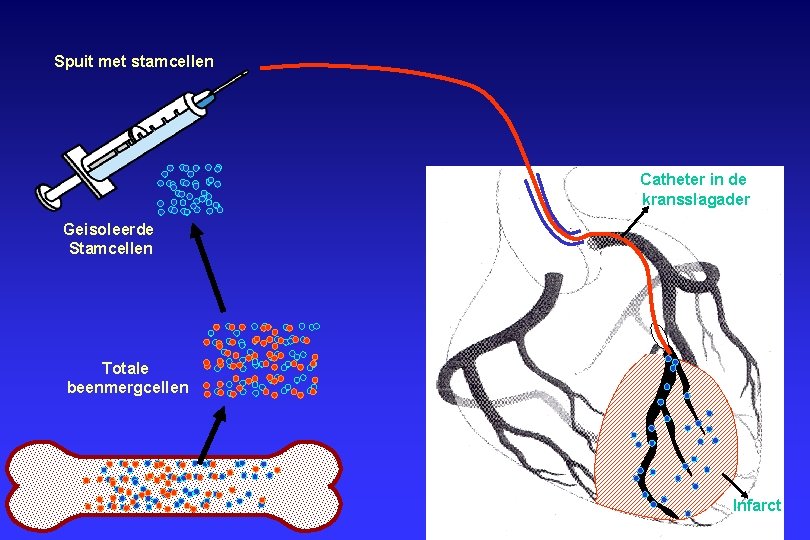 Spuit met stamcellen Catheter in de kransslagader Geisoleerde Stamcellen Totale beenmergcellen Infarct 