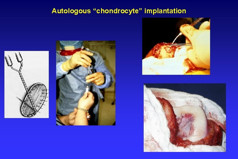 Autologous “chondrocyte” implantation 