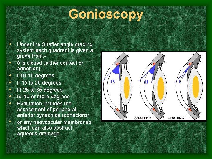 Gonioscopy • Under the Shaffer angle grading • • system each quadrant is given