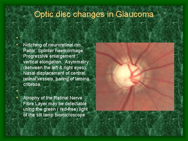 Optic disc changes in Glaucoma • • Notching of neuroretinal rim, • • Pallor,