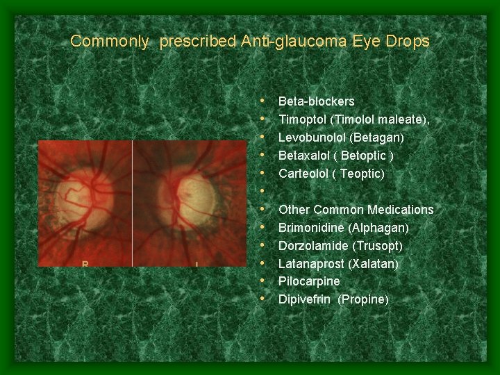 Commonly prescribed Anti-glaucoma Eye Drops • • • Beta-blockers Timoptol (Timolol maleate), Levobunolol (Betagan)